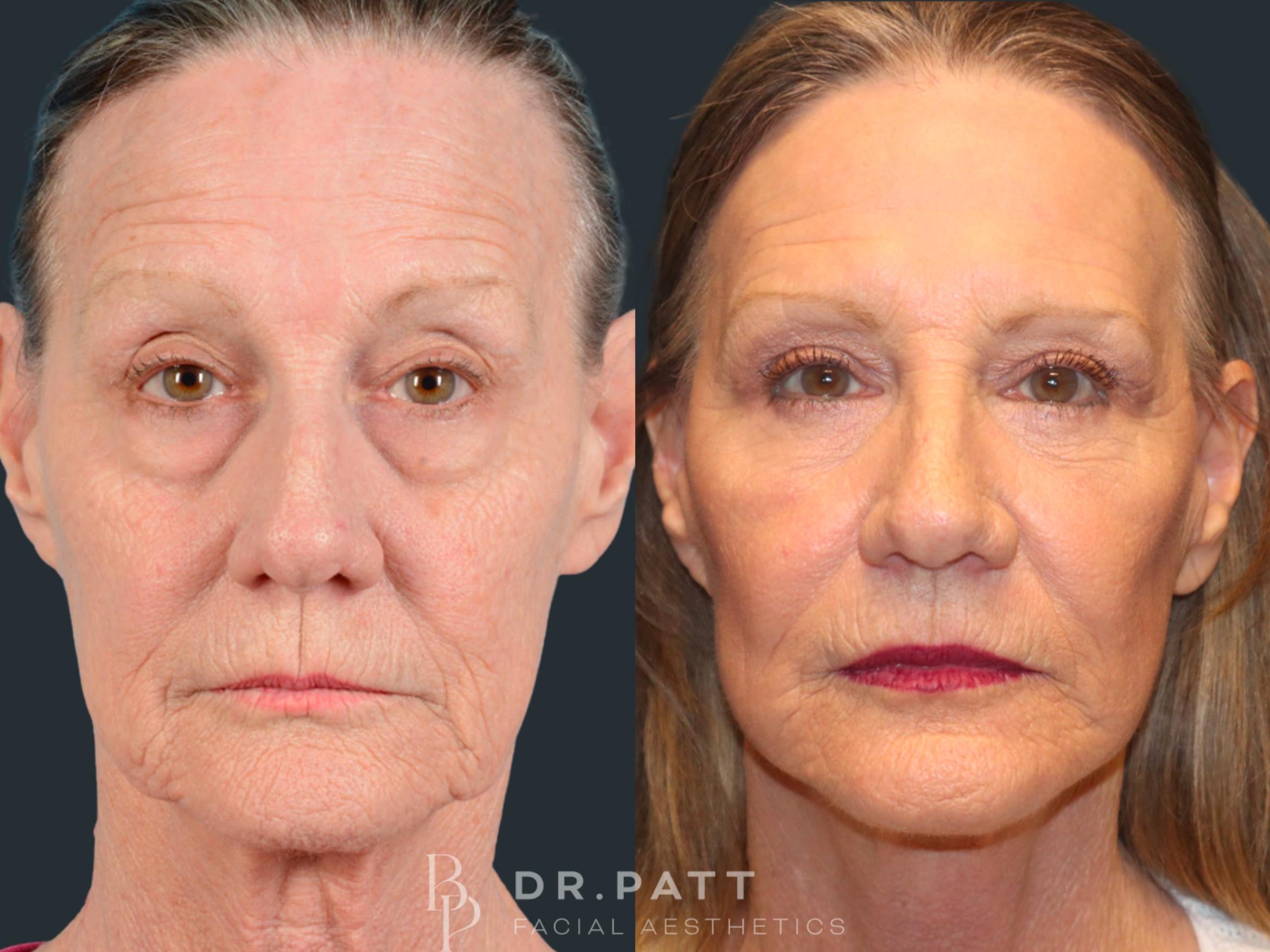 Before & After Deep Plane Facelift Case 44 Front View in Houston, TX