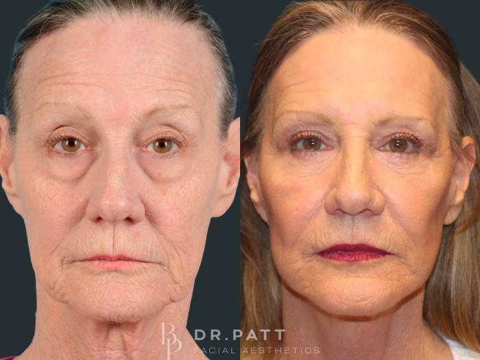 Before & After Deep Plane Facelift Case 44 Front View in Houston, TX