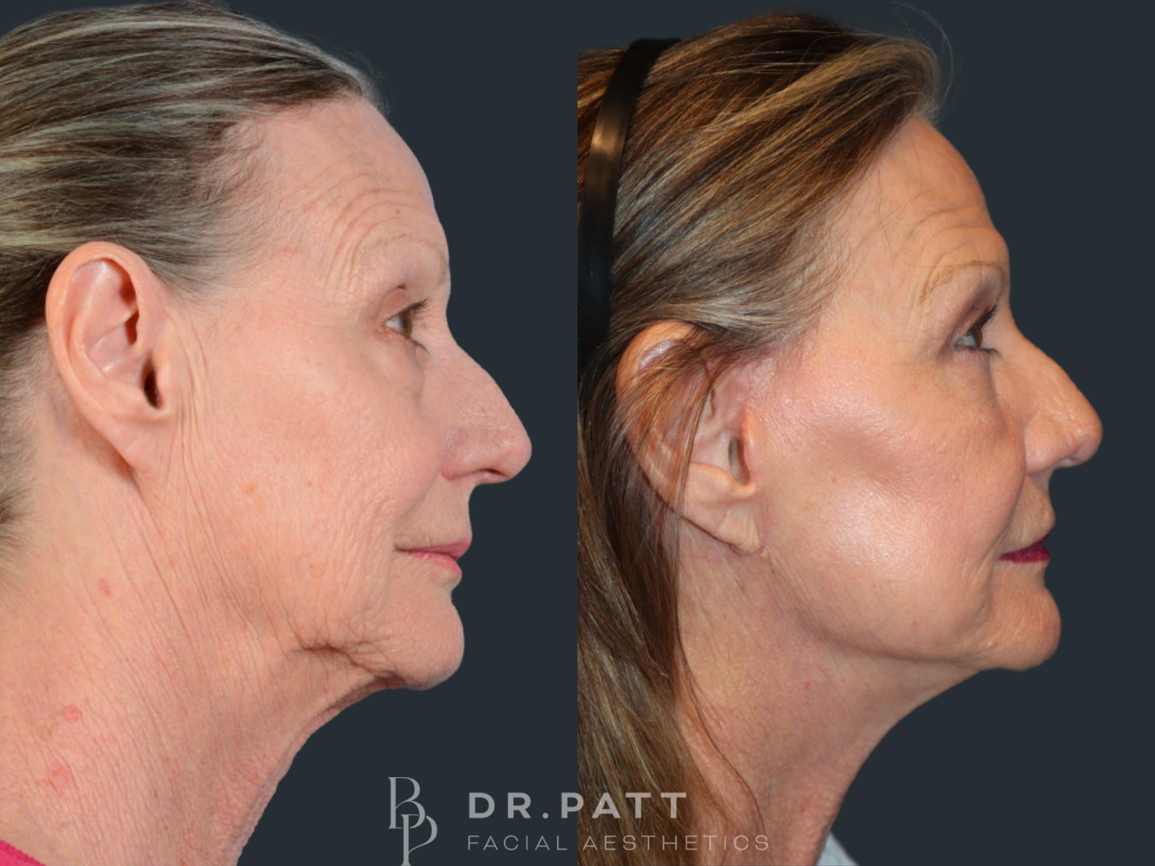 Before & After Deep Plane Facelift Case 44 Right Side View in Houston, TX