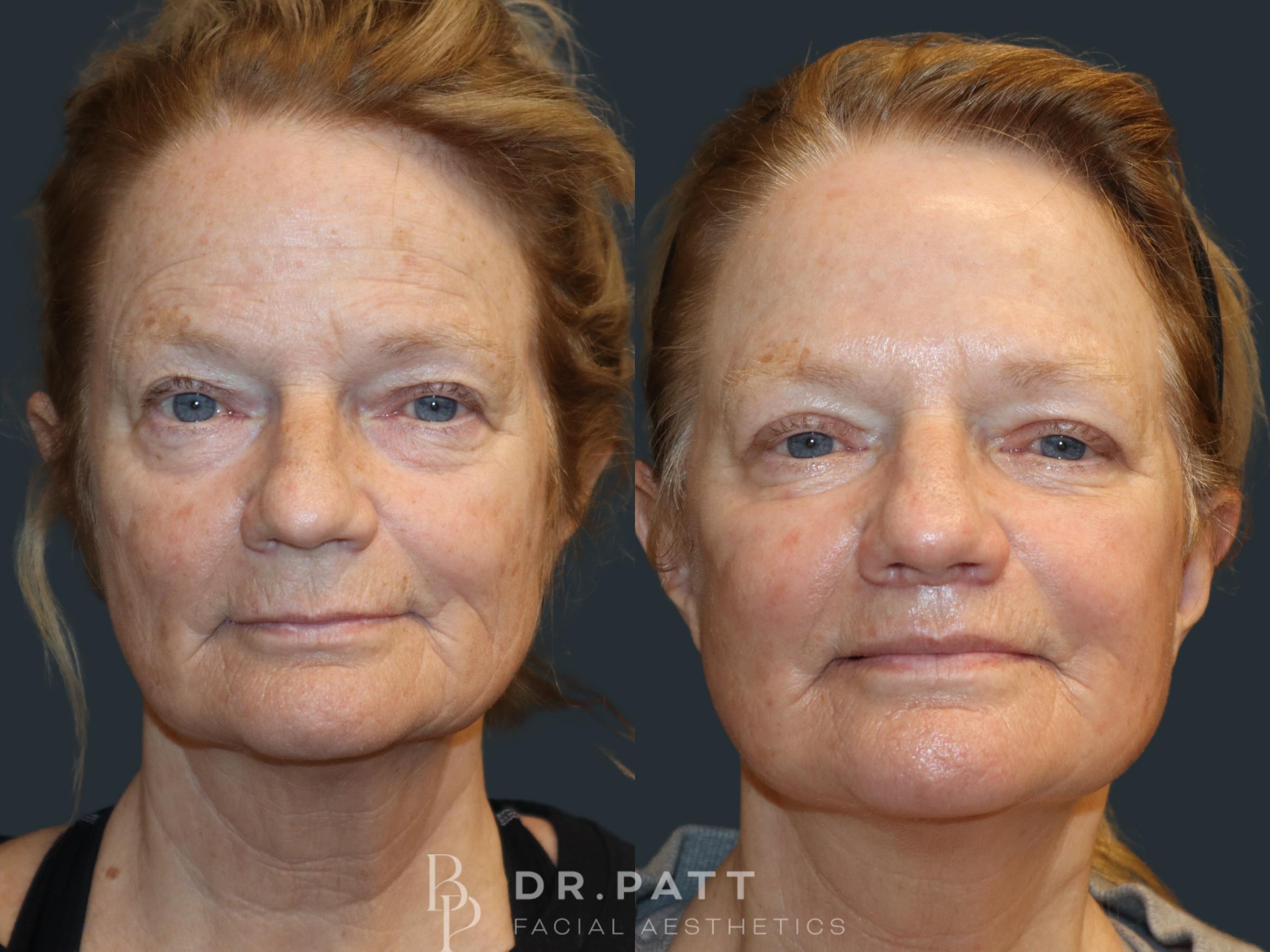 Before & After Deep Plane Facelift Case 9 Front 1 View in Houston, TX