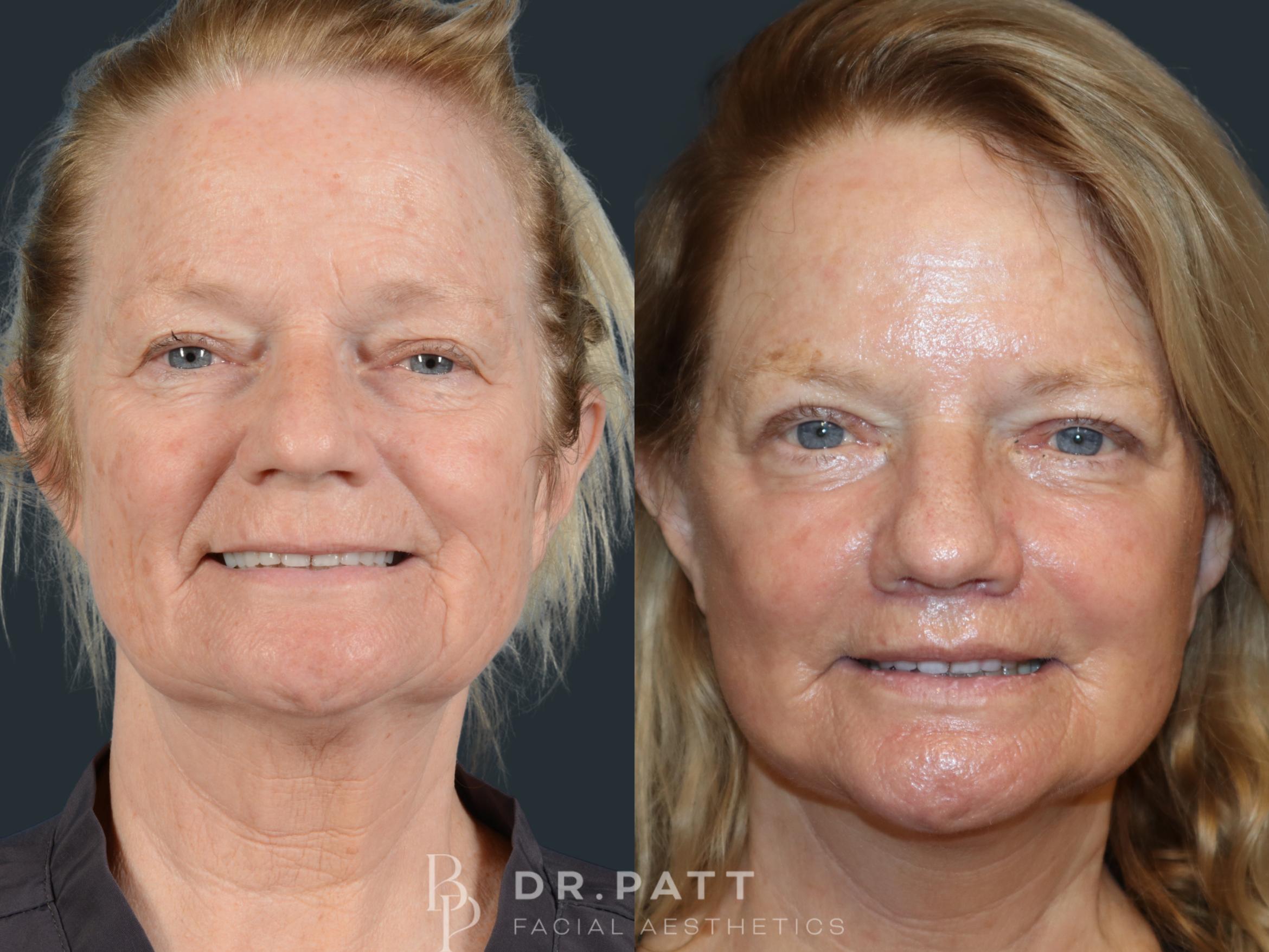 Before & After Deep Plane Facelift Case 9 Front 2 View in Houston, TX