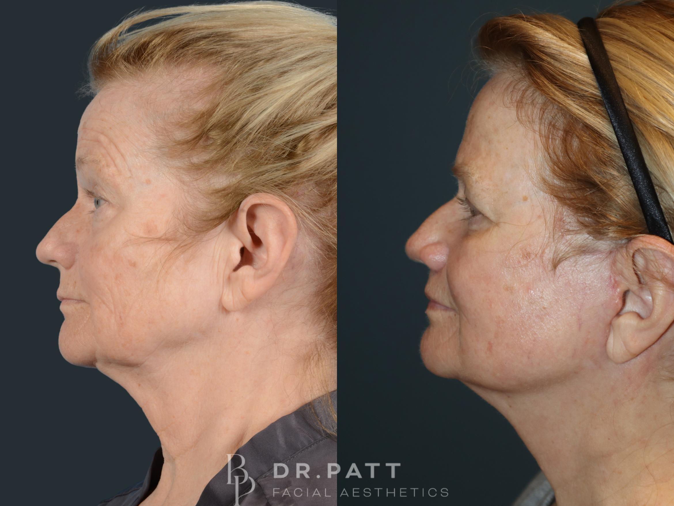 Before & After Deep Plane Facelift Case 9 Left Side View in Houston, TX