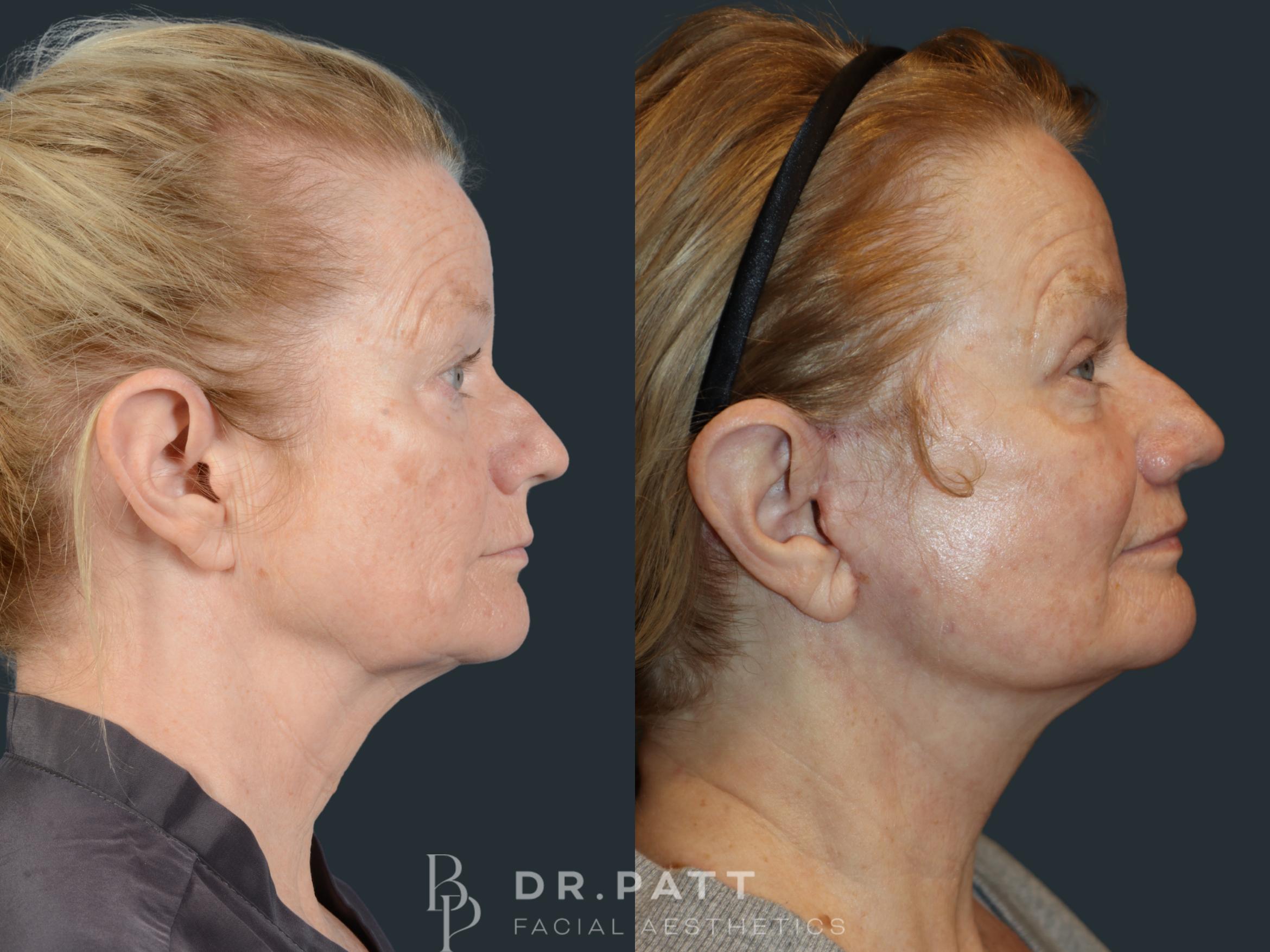 Before & After Deep Plane Facelift Case 9 Right Side View in Houston, TX