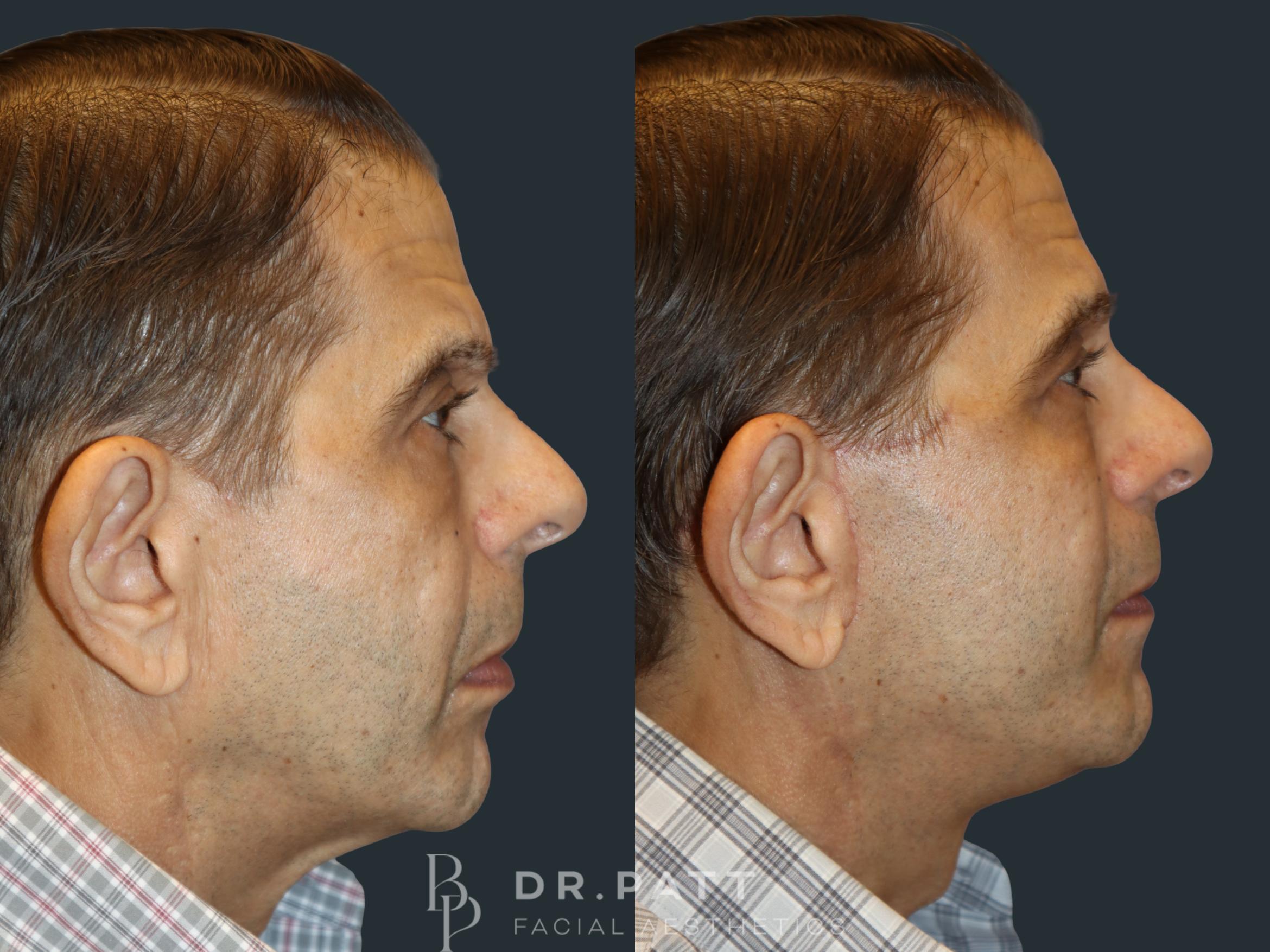 Before & After Facelift Case 10 Right Side View in Houston, TX