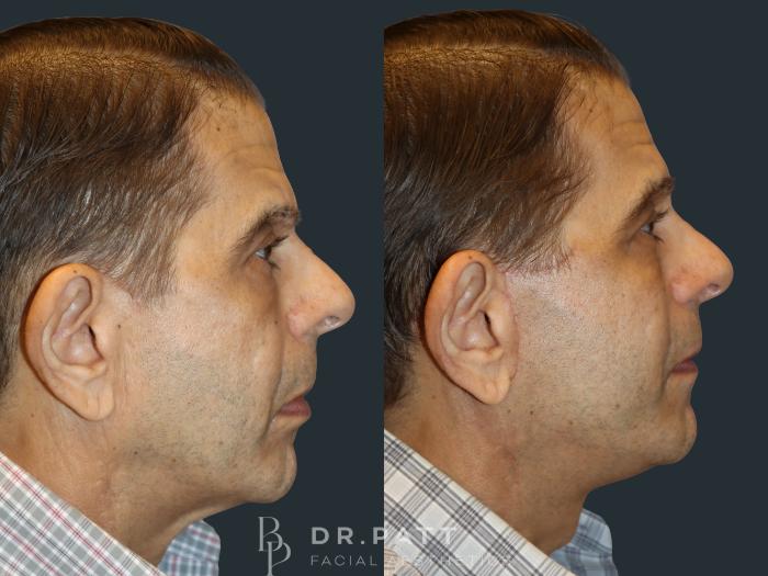 Before & After Facelift Case 10 Right Side View in Houston, TX
