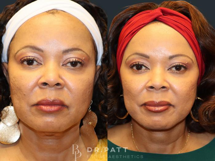 Before & After Facelift Case 11 Front 1 View in Houston, TX