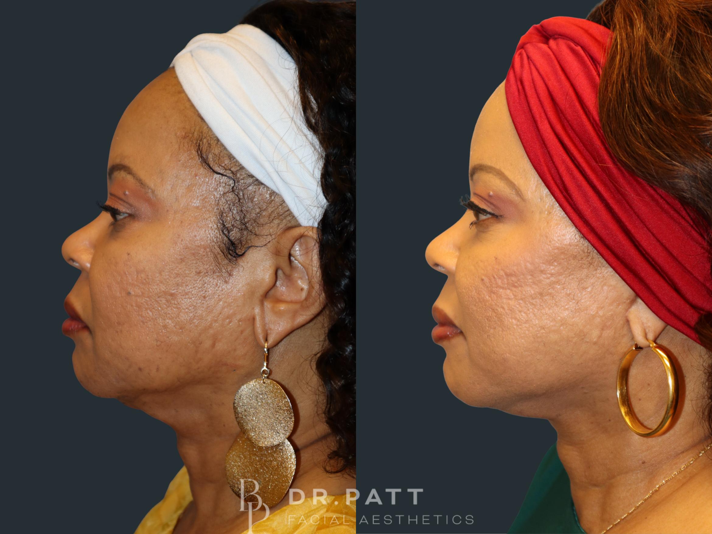 Before & After Facelift Case 11 Left Side View in Houston, TX