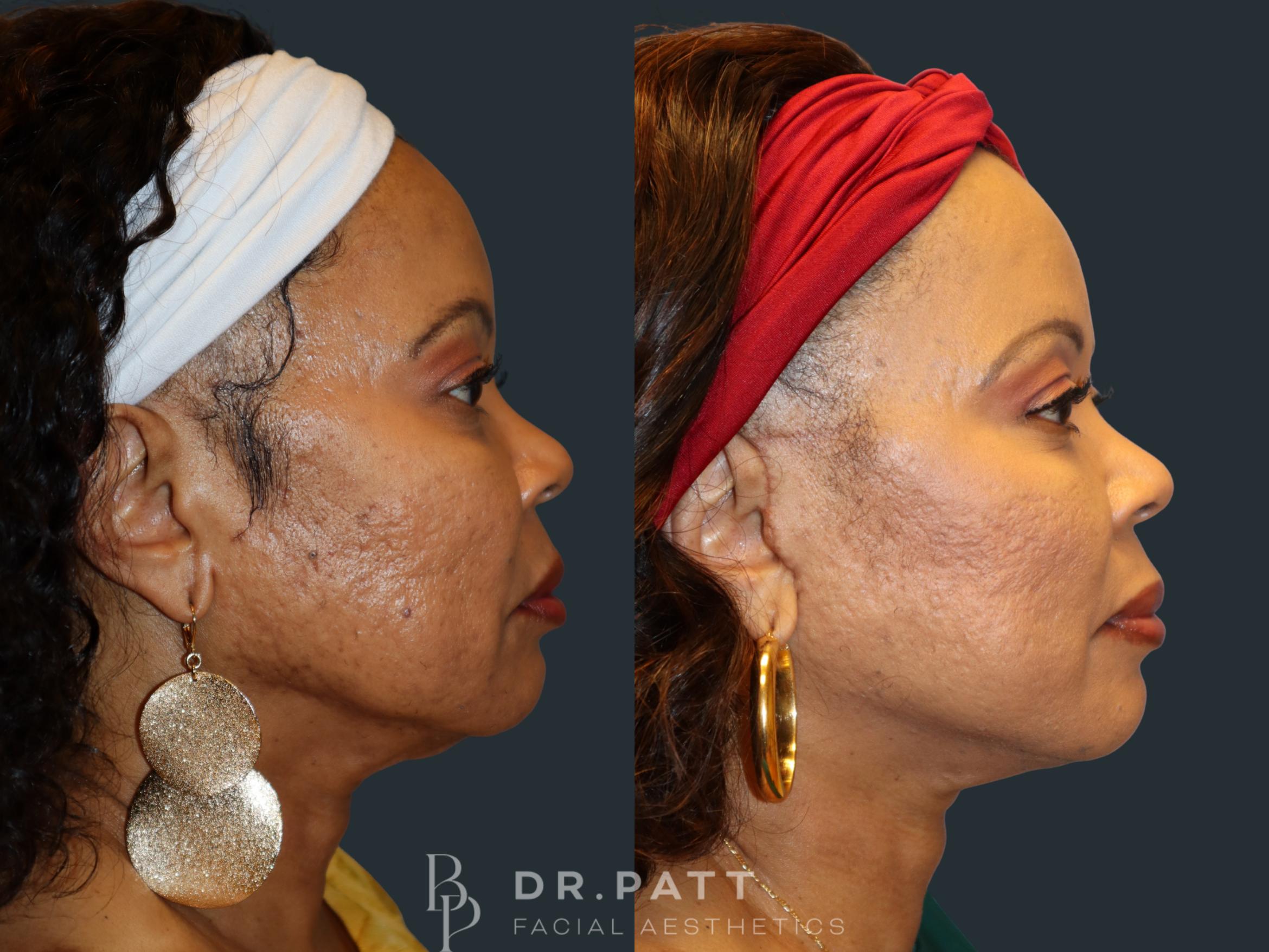 Before & After Facelift Case 11 Right Side View in Houston, TX