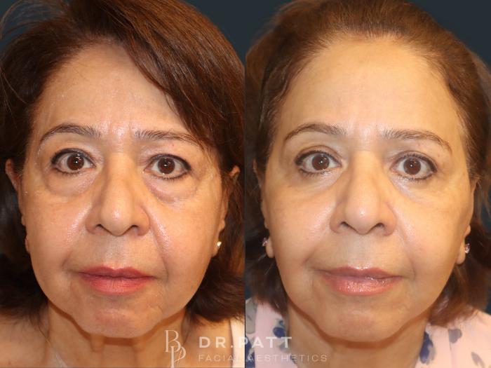 Before & After Facelift Case 39 Front View in Houston, TX