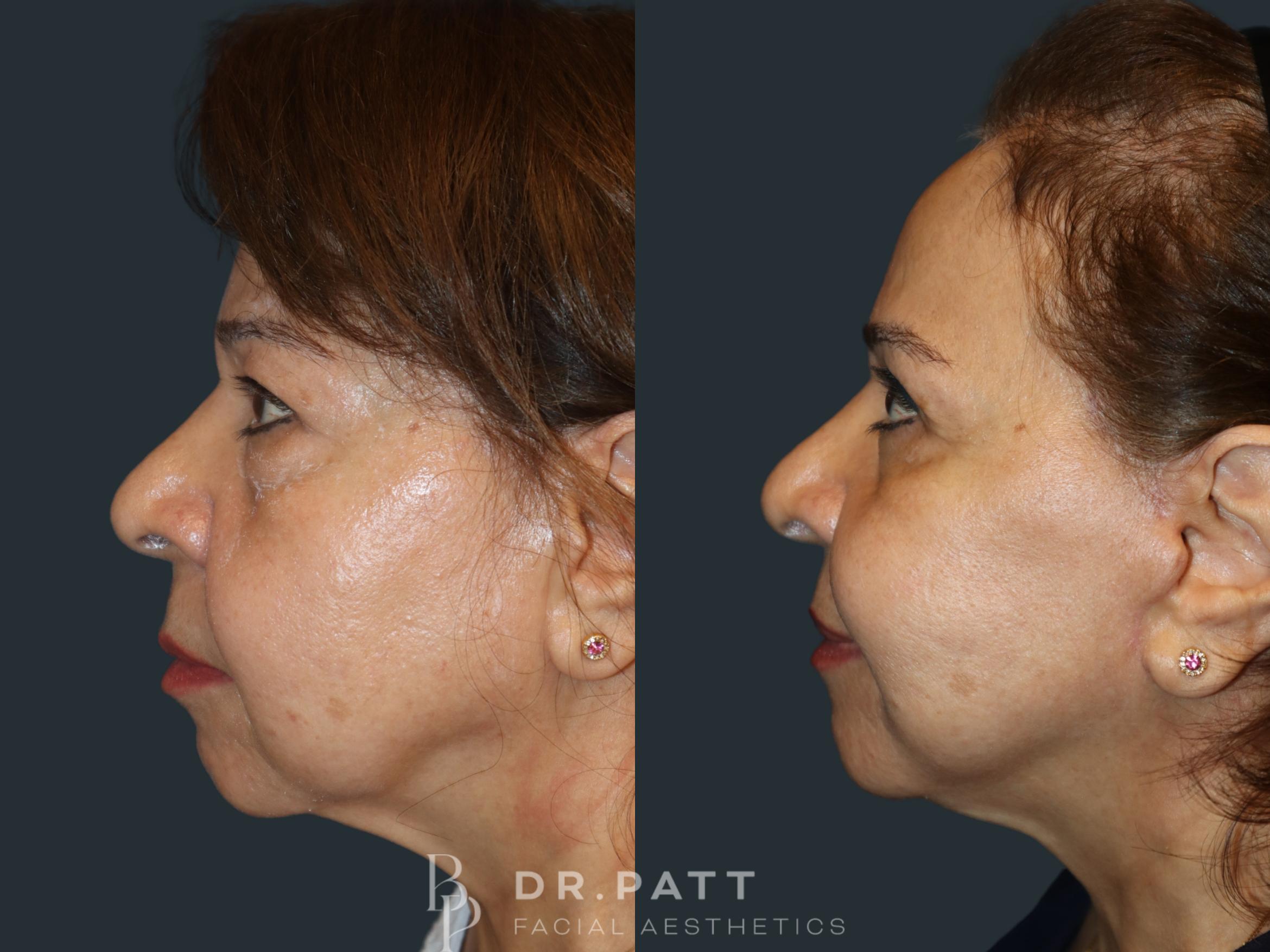 Before & After Facelift Case 39 Left Side View in Houston, TX