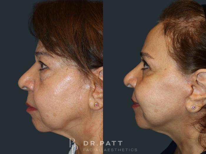 Before & After Facelift Case 39 Left Side View in Houston, TX