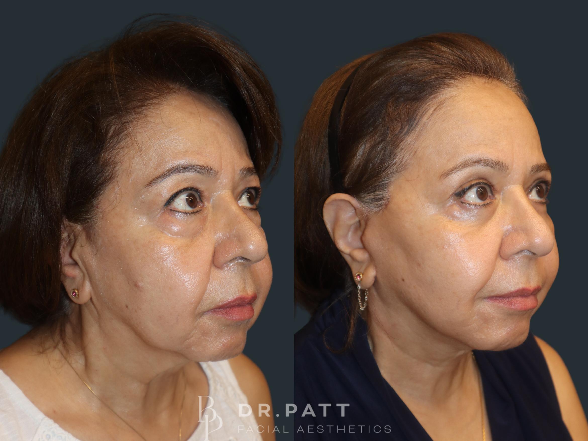 Before & After Facelift Case 39 Right Oblique View in Houston, TX