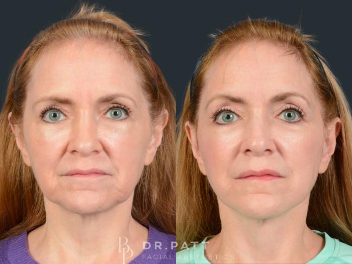 Before & After Facelift Case 43 Front View in Houston, TX