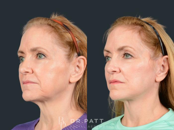 Before & After Facelift Case 43 Left Oblique View in Houston, TX