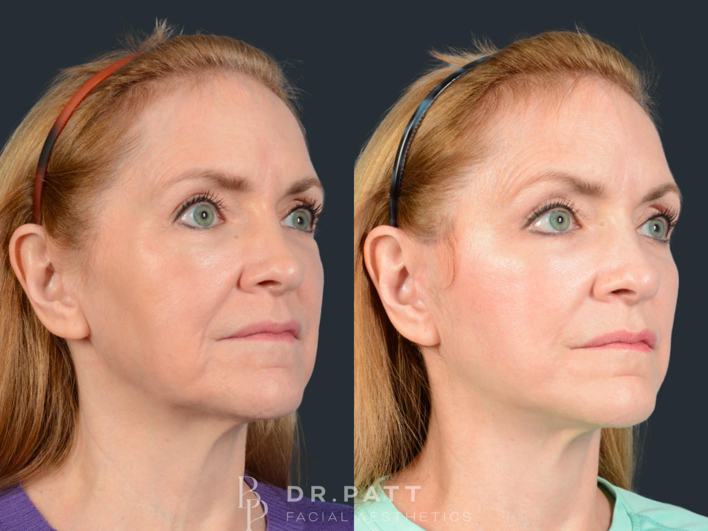 Before & After Facelift Case 43 Right Side View in Houston, TX