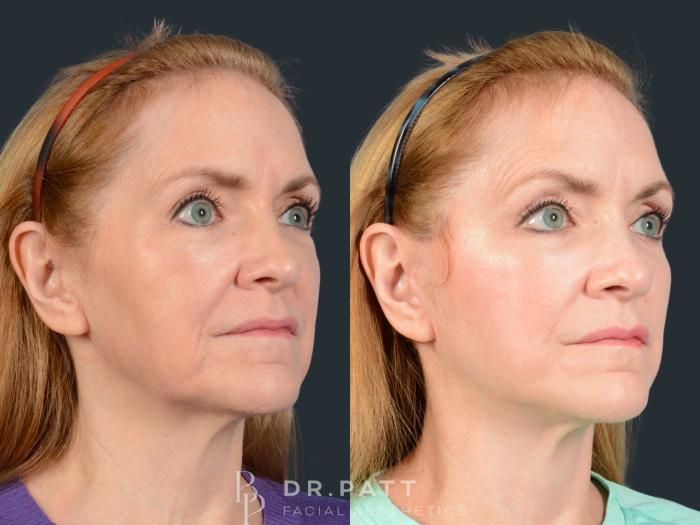 Before & After Facelift Case 43 Right Side View in Houston, TX