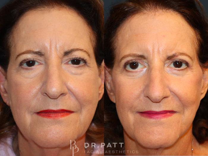 Before & After Facelift Case 46 Front View in Houston, TX