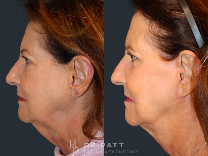Before & After Facelift Case 46 Left Side View in Houston, TX