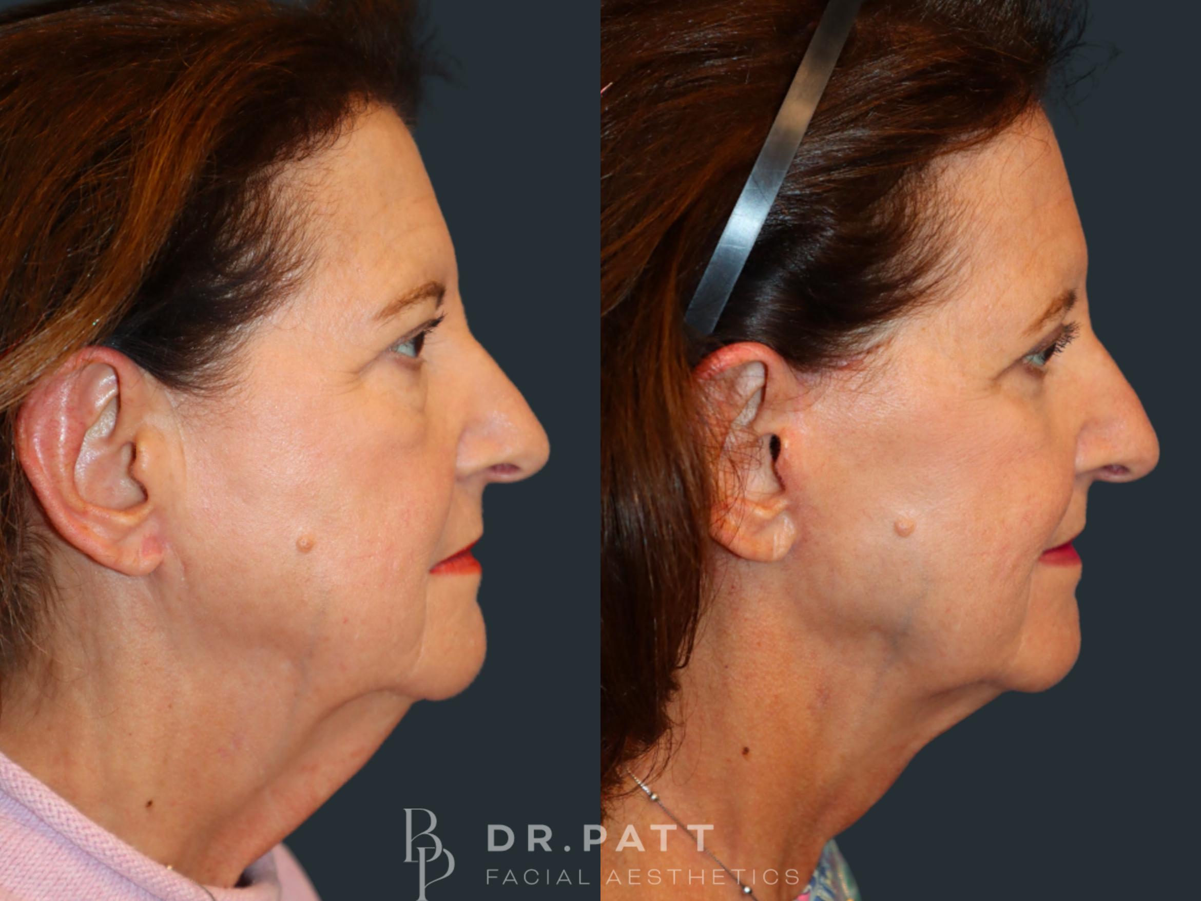 Before & After Facelift Case 46 Right Side View in Houston, TX