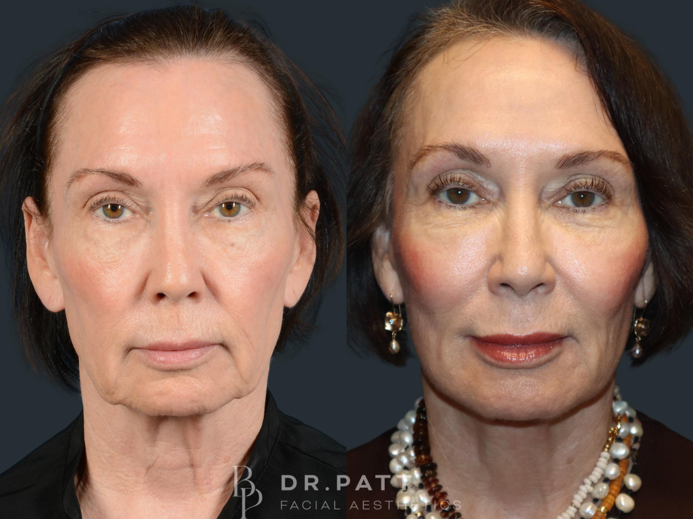 Before & After Facelift Case 48 Front View in Houston, TX