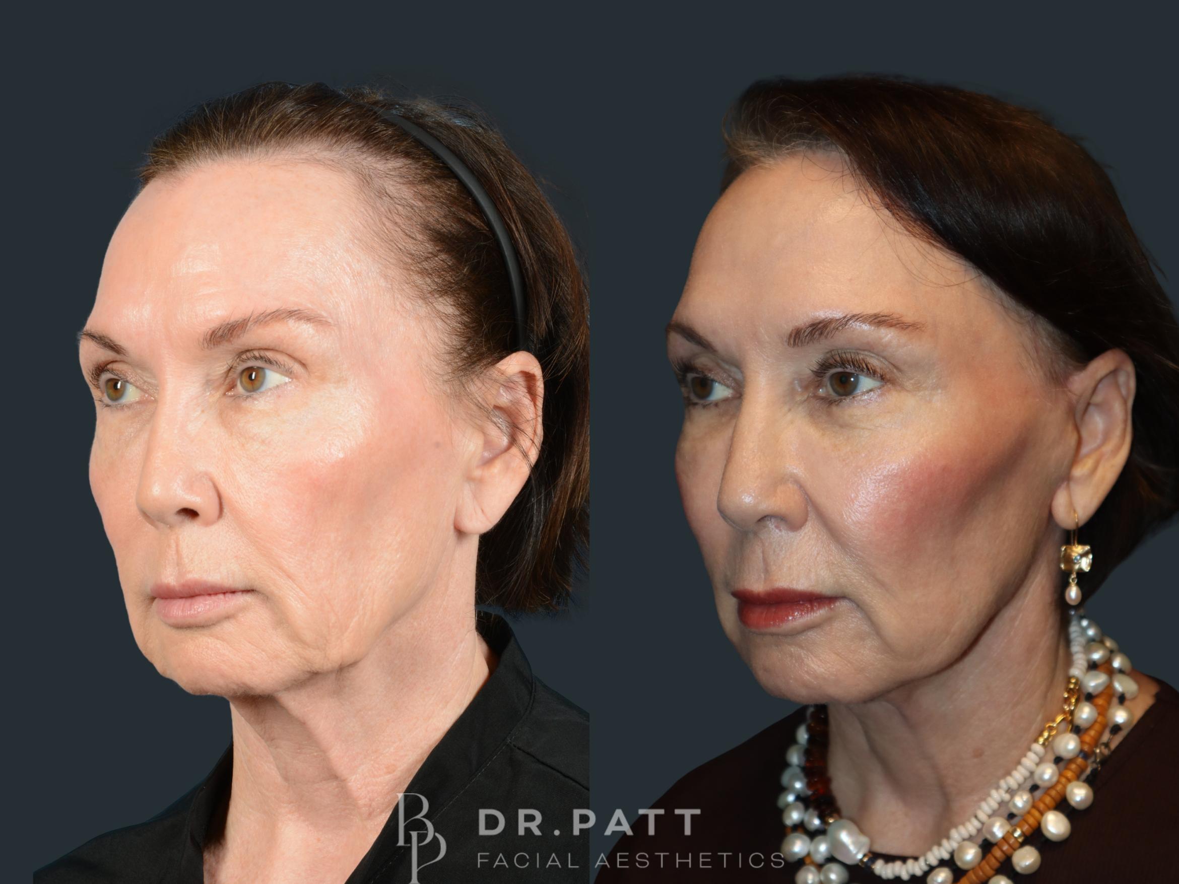 Before & After Facelift Case 48 Left Oblique View in Houston, TX