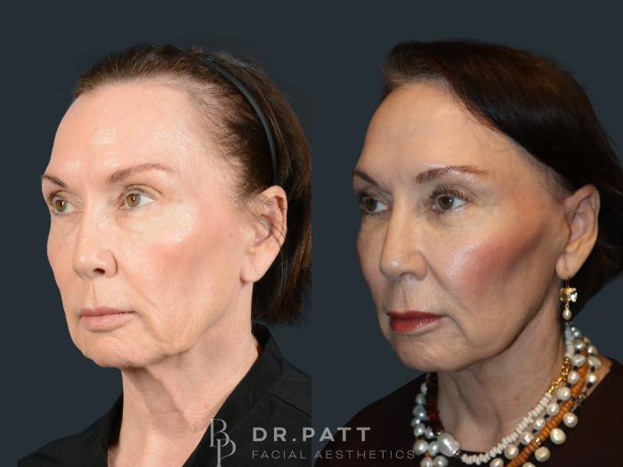 Before & After Facelift Case 48 Left Oblique View in Houston, TX