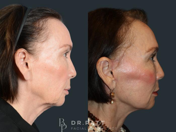 Before & After Facelift Case 48 Right Side View in Houston, TX