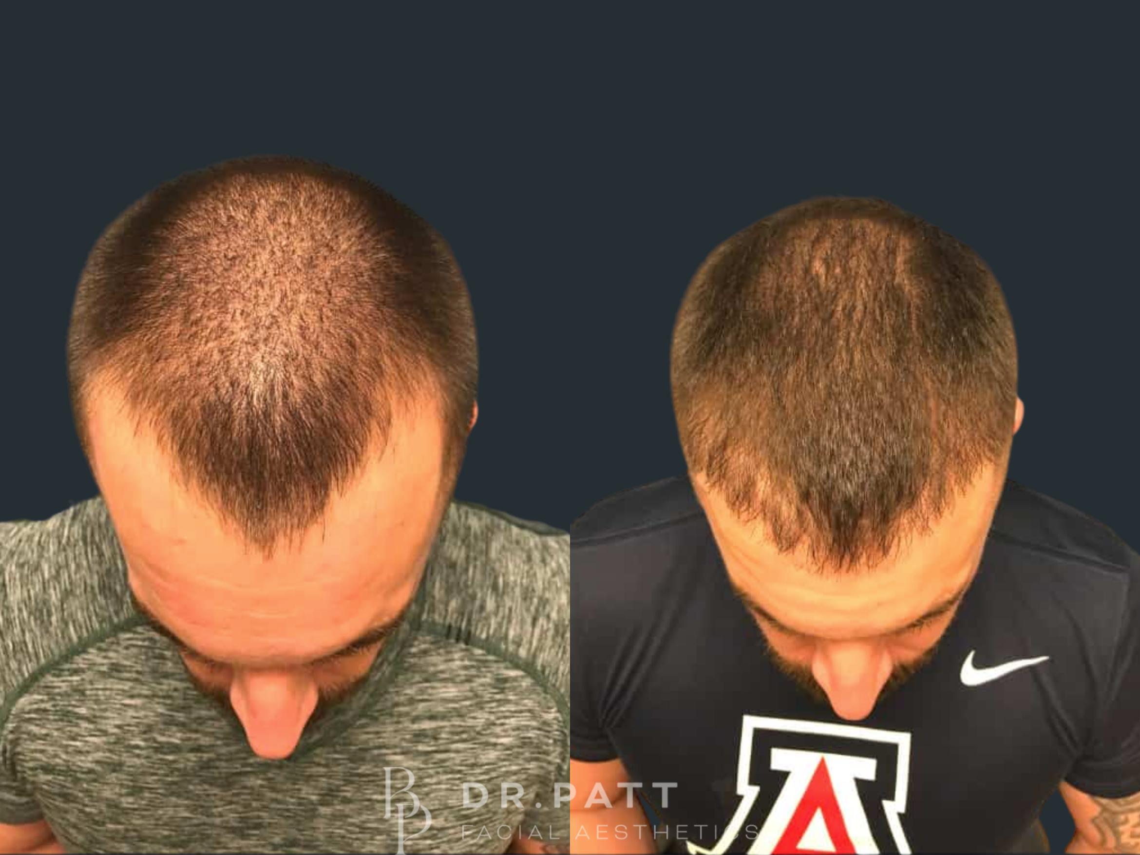 Before & After Hair Restoration Case 12 Front 1 View in Houston, TX