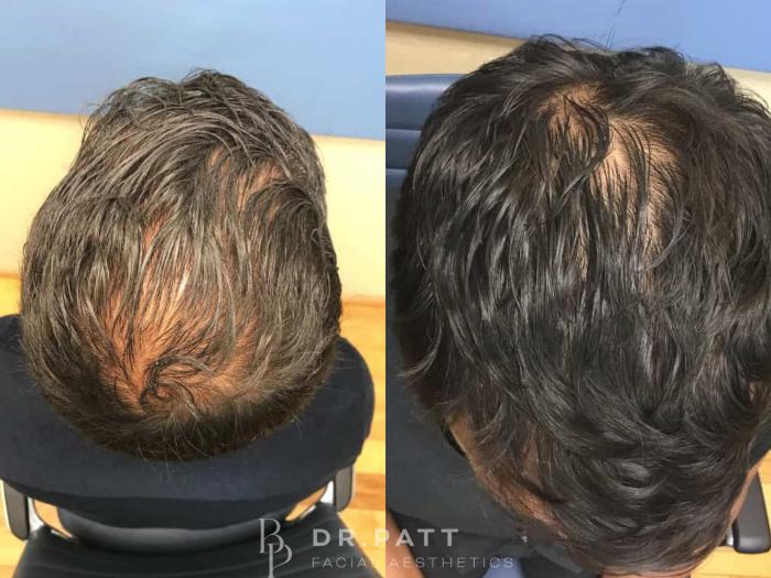 Before & After Hair Restoration Case 13 Front 1 View in Houston, TX