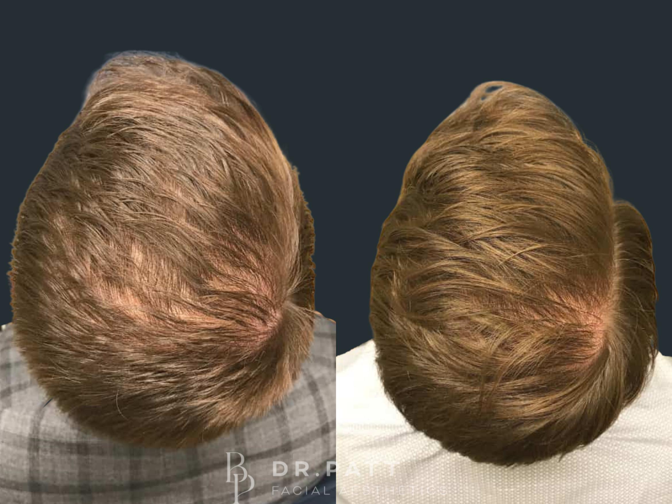 Before & After Hair Restoration Case 14 Front 1 View in Houston, TX