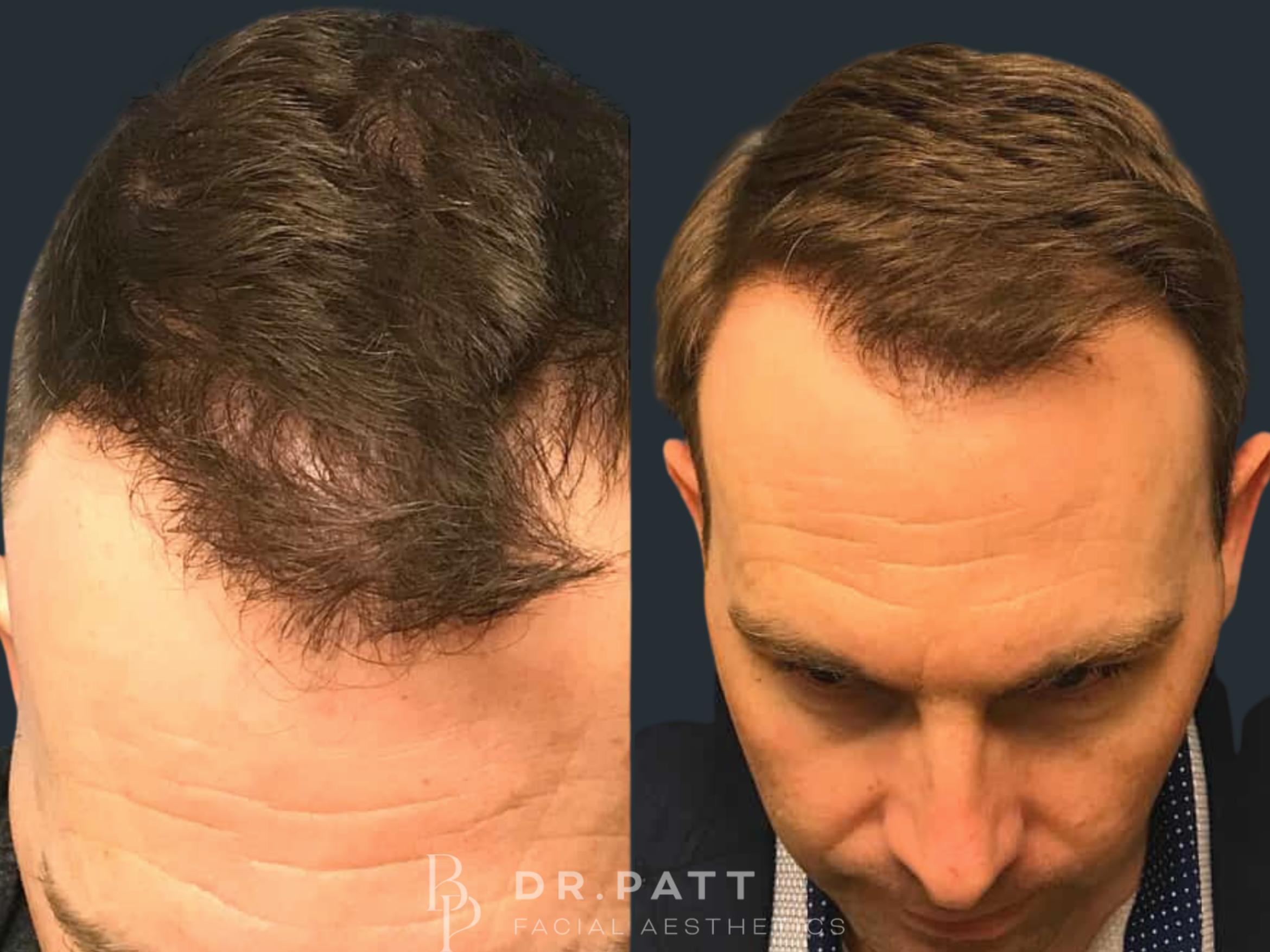 Before & After Hair Restoration Case 15 Front 1 View in Houston, TX