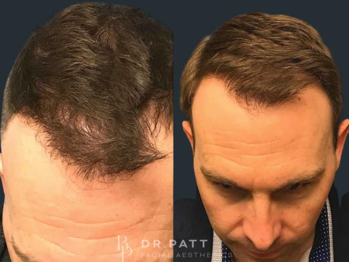 Before & After Hair Restoration Case 15 Front 1 View in Houston, TX
