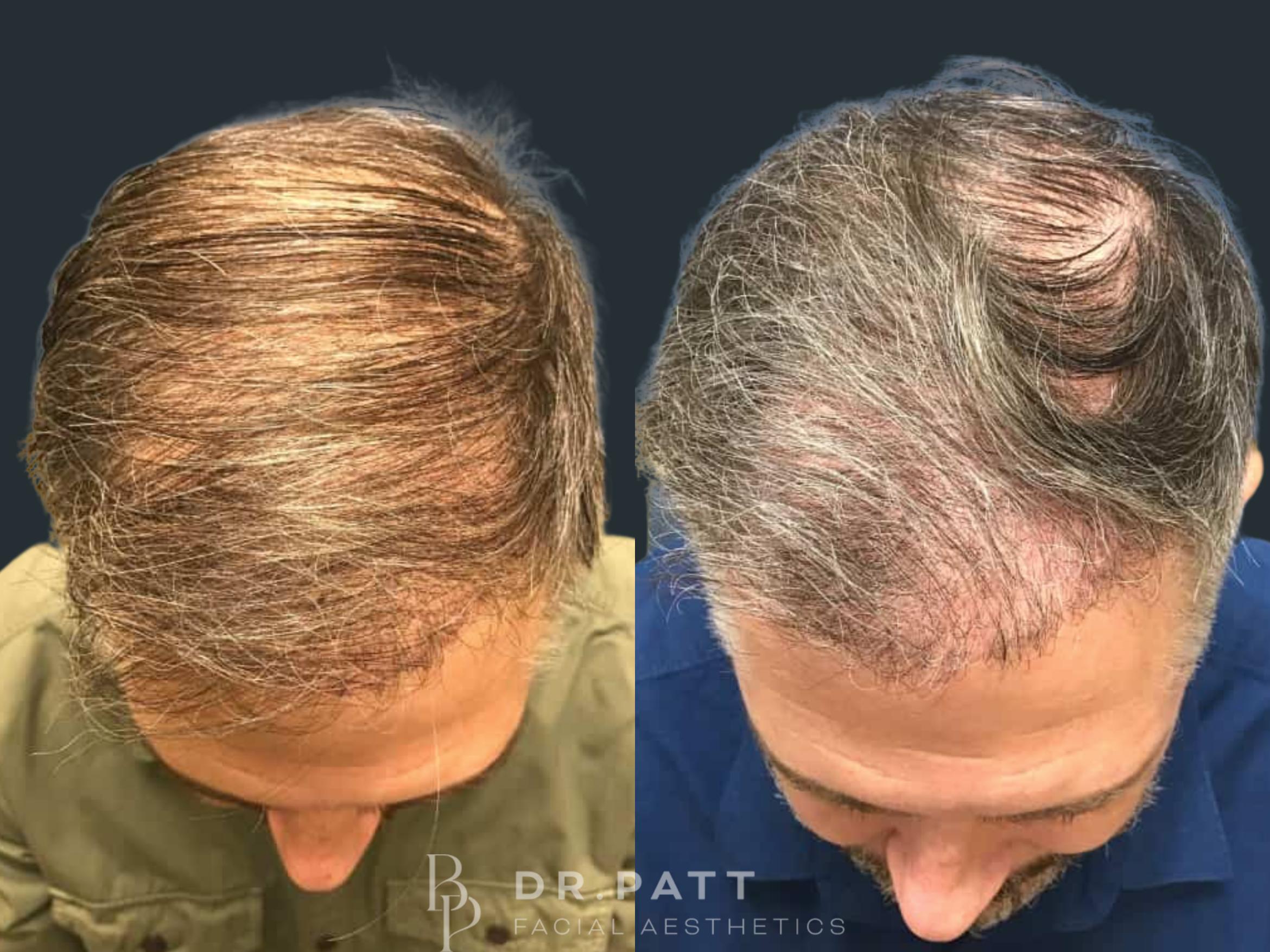Before & After Hair Restoration Case 16 Front 1 View in Houston, TX