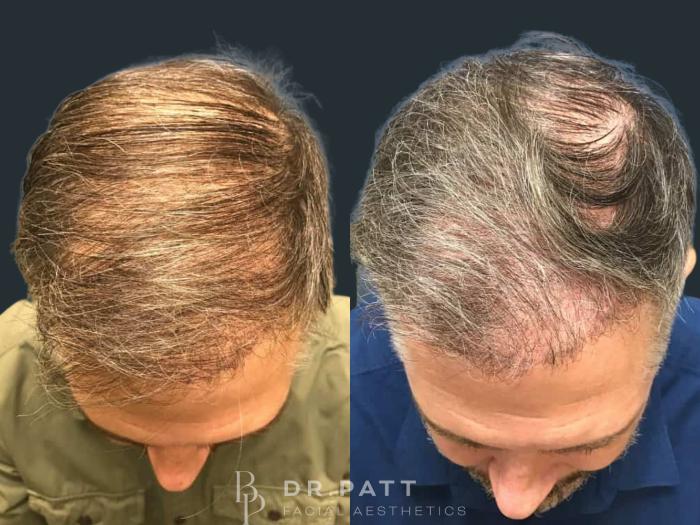 Before & After Hair Restoration Case 16 Front 1 View in Houston, TX