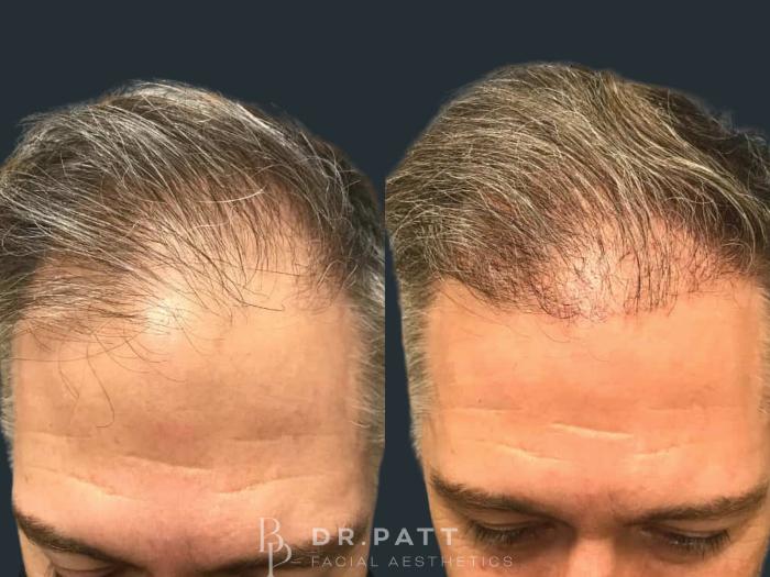 Before & After Hair Restoration Case 16 Front 2 View in Houston, TX