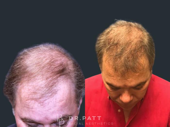 Before & After Hair Restoration Case 17 Front 1 View in Houston, TX