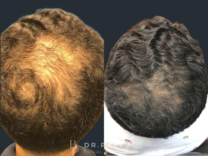 Before & After Hair Restoration Case 18 Front 1 View in Houston, TX