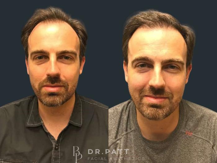 Before & After Hair Restoration Case 19 Front 1 View in Houston, TX