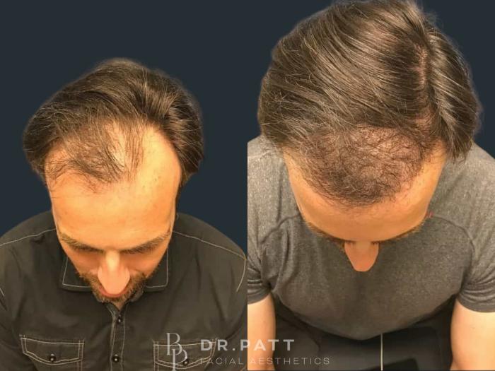 Before & After Hair Restoration Case 19 Front 2 View in Houston, TX
