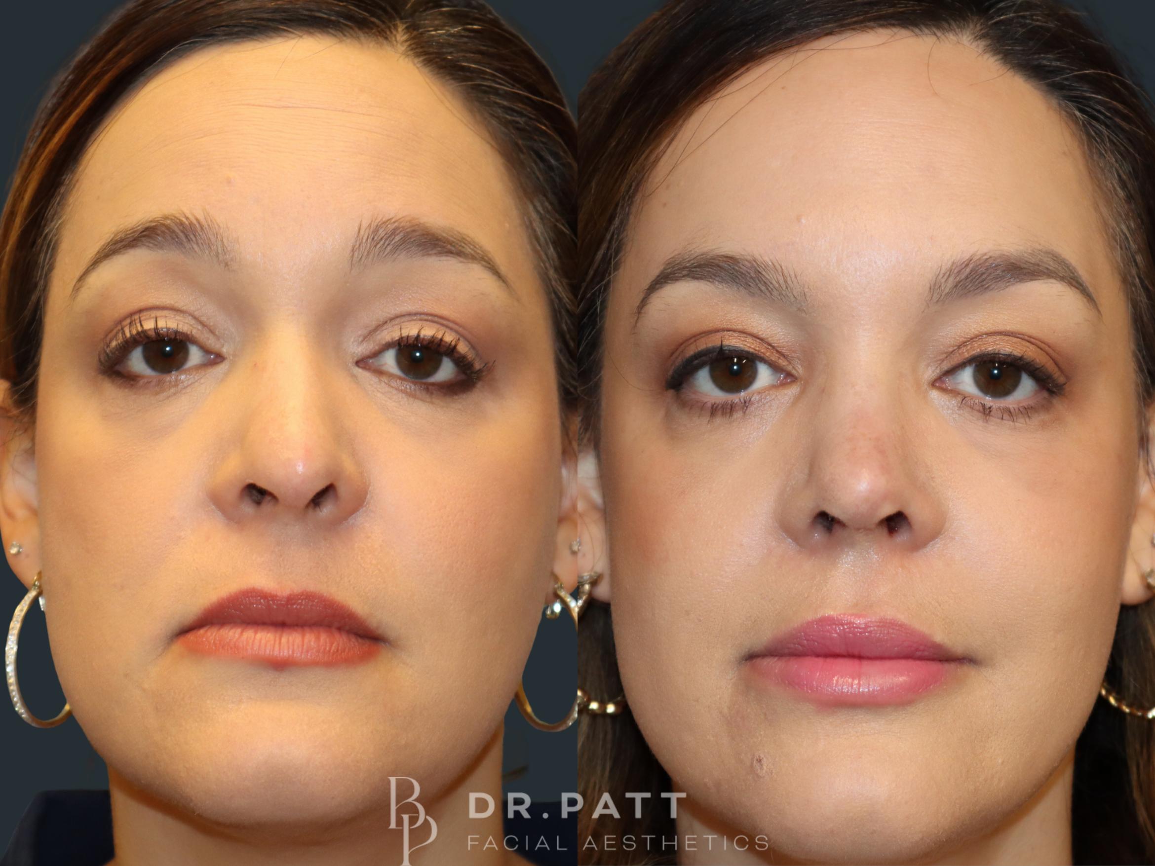 Before & After Rhinoplasty (Nose Job) Case 1 Front 1 View in Houston, TX