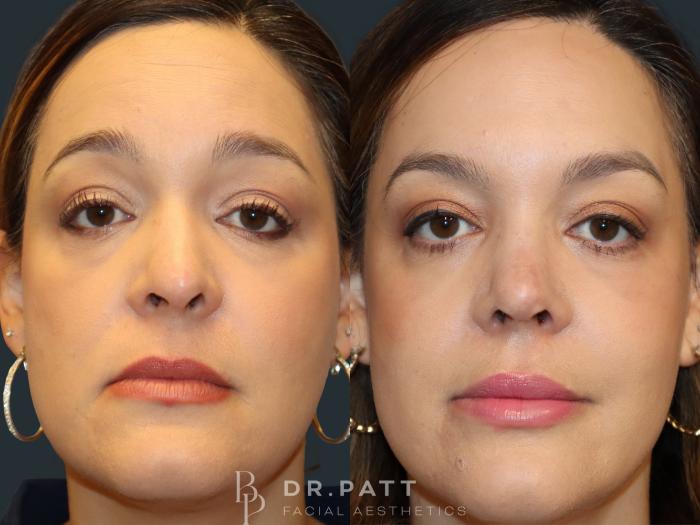 Before & After Rhinoplasty (Nose Job) Case 1 Front 1 View in Houston, TX