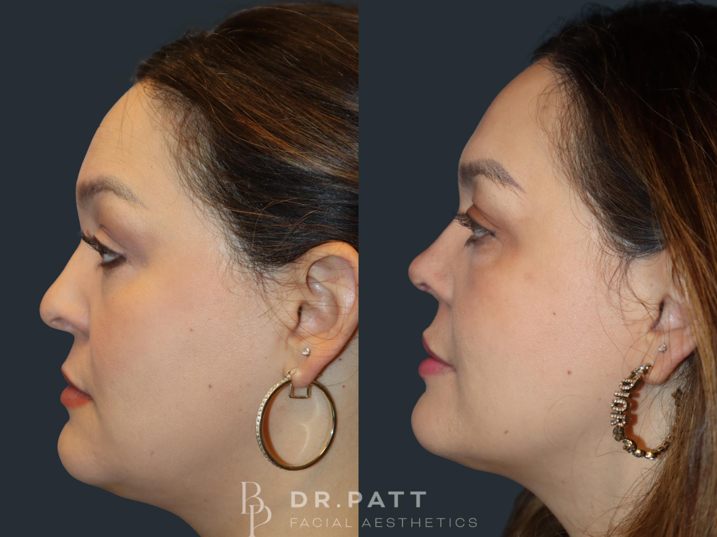 Before & After Rhinoplasty (Nose Job) Case 1 Left Side View in Houston, TX