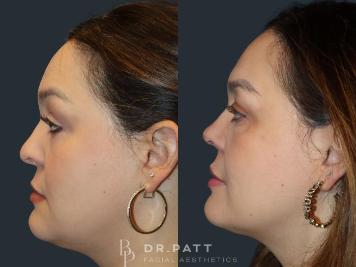 Before & After Rhinoplasty (Nose Job) Case 1 Left Side View in Houston, TX