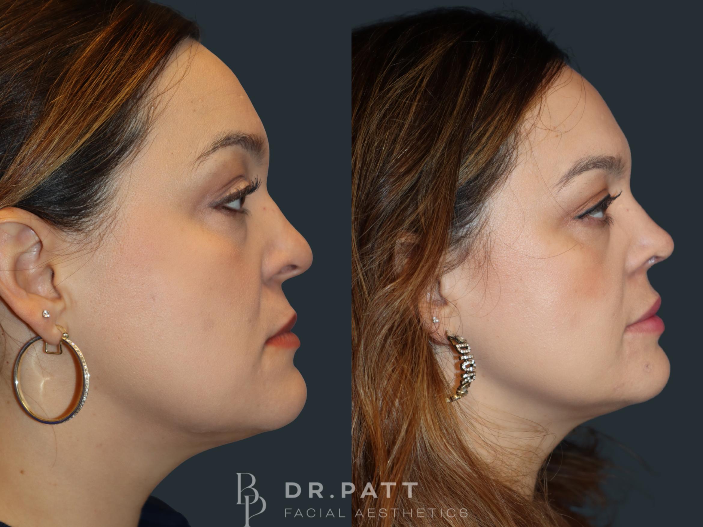 Before & After Rhinoplasty (Nose Job) Case 1 Right Side View in Houston, TX