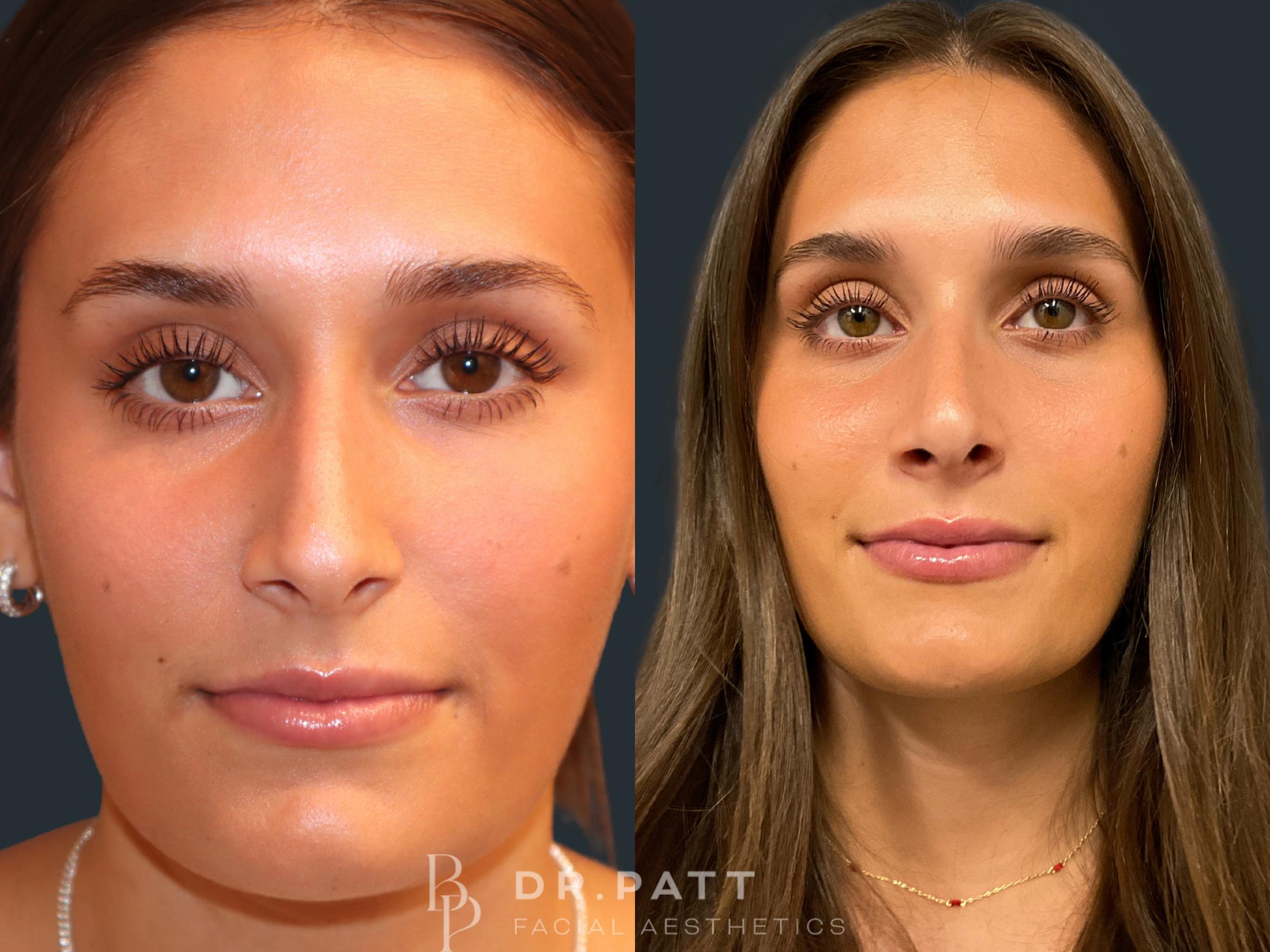 Before & After Rhinoplasty (Nose Job) Case 2 Front 1 View in Houston, TX