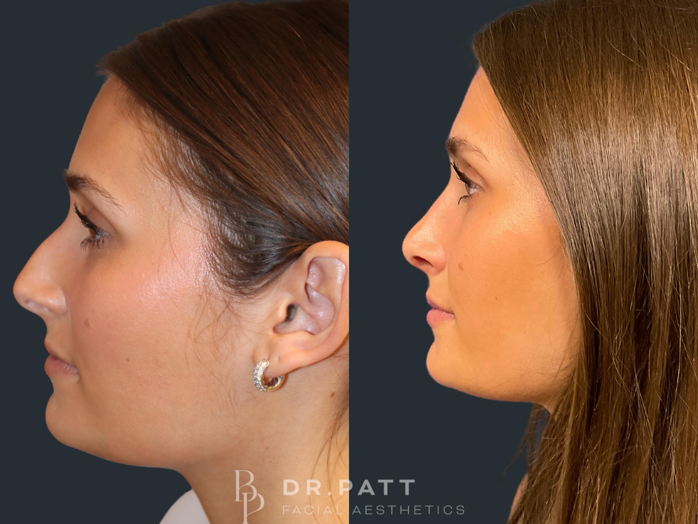 Before & After Rhinoplasty (Nose Job) Case 2 Left Side View in Houston, TX