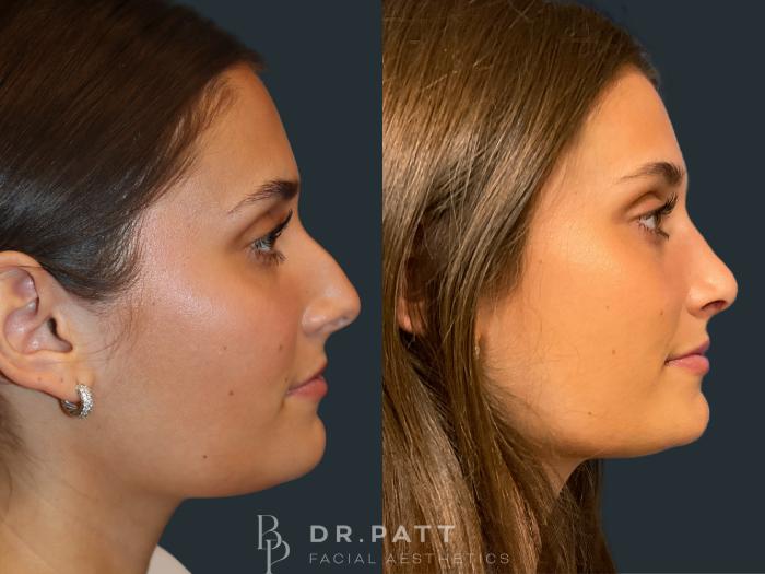 Before & After Rhinoplasty (Nose Job) Case 2 Right Side View in Houston, TX
