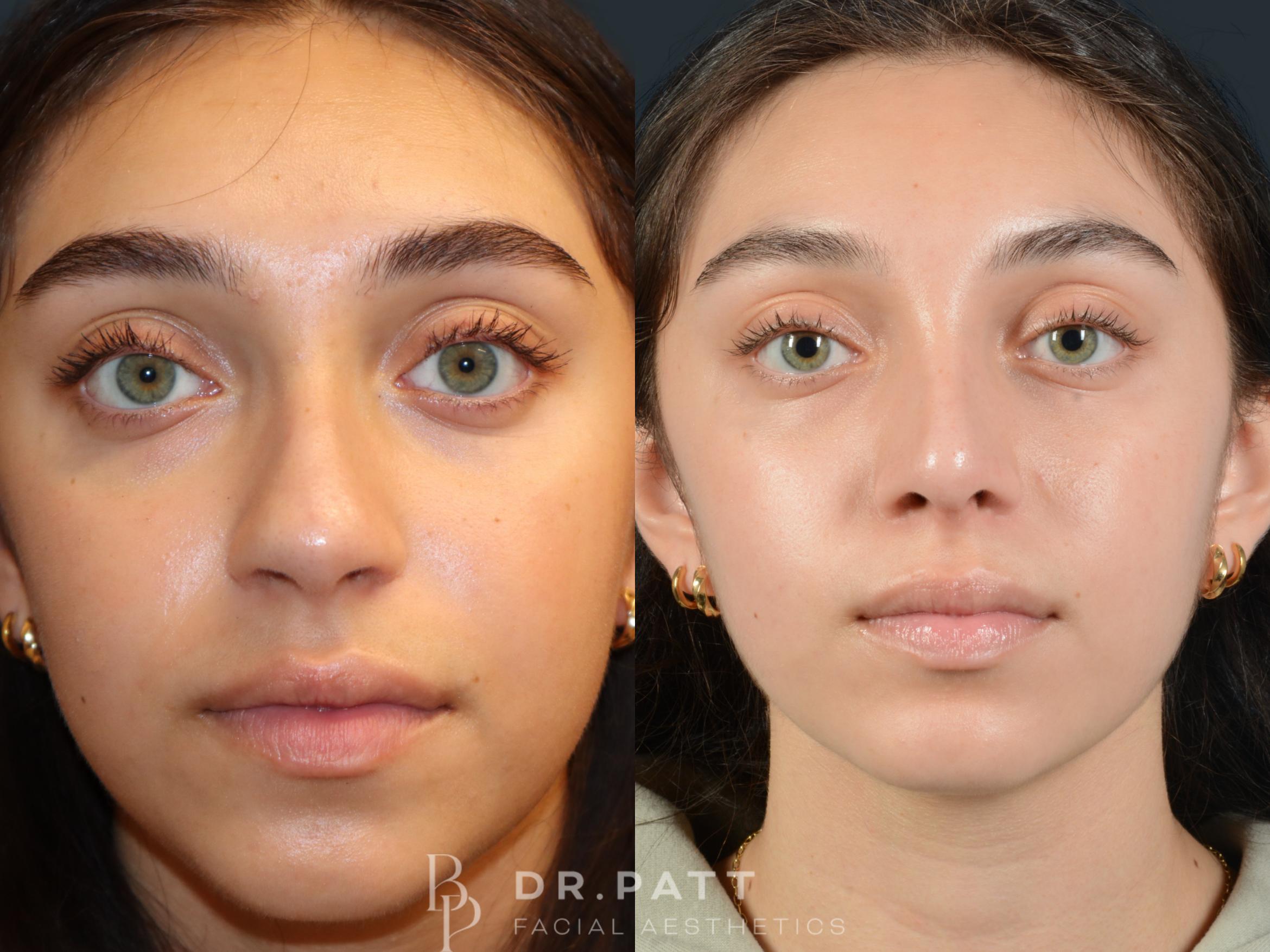 Before & After Rhinoplasty (Nose Job) Case 28 Front 1 View in Houston, TX