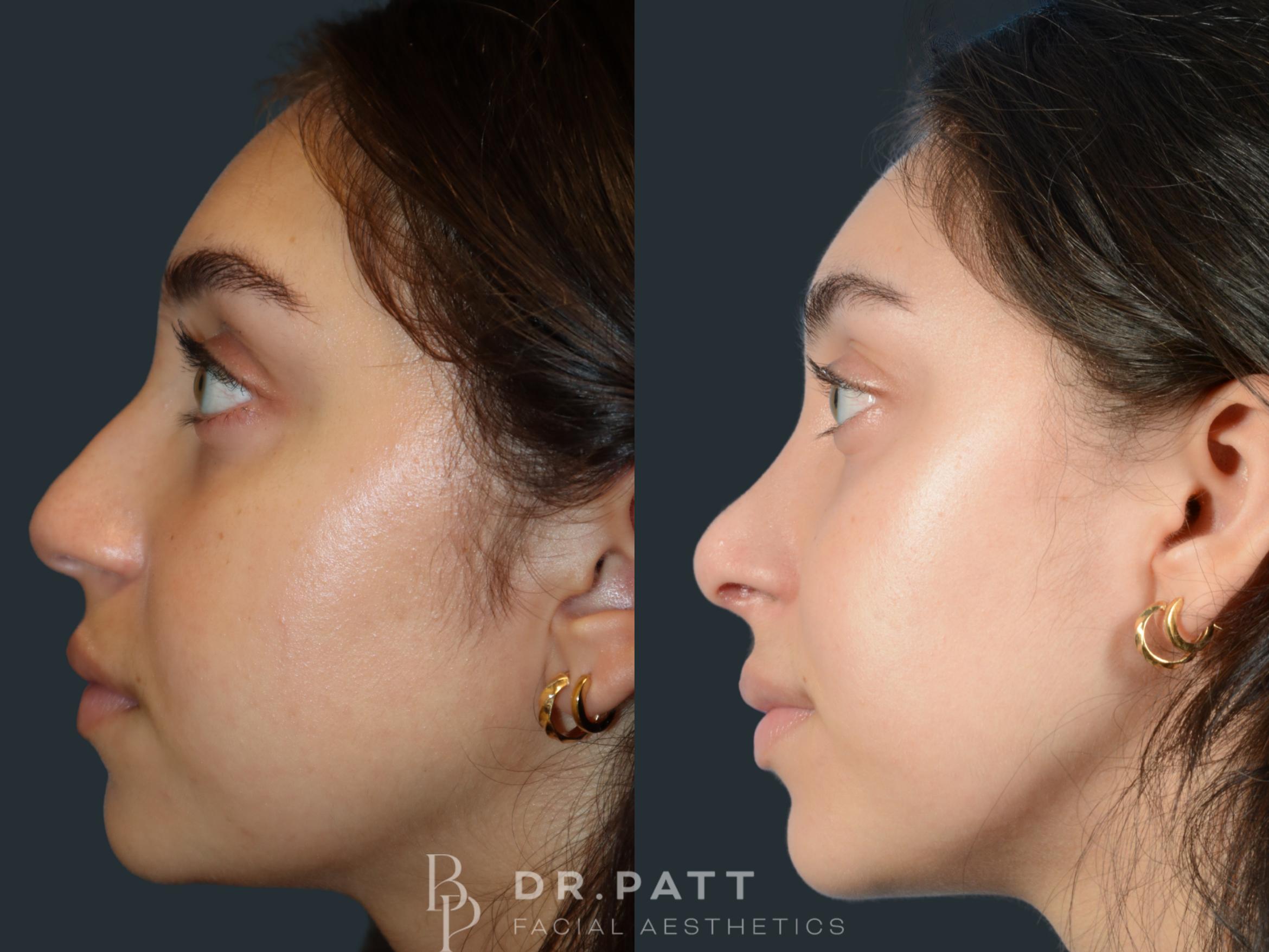 Before & After Rhinoplasty (Nose Job) Case 28 Left Side View in Houston, TX