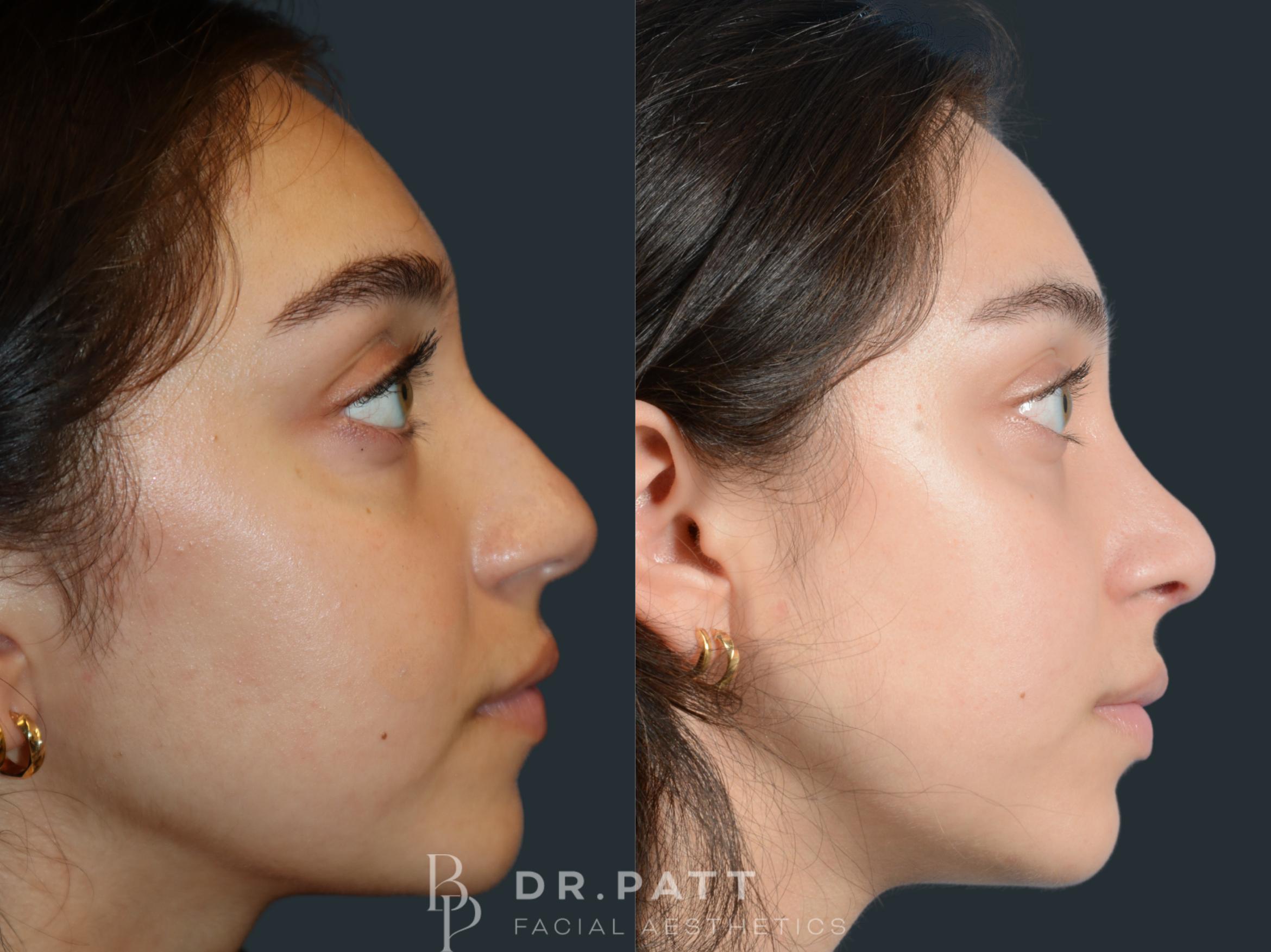 Before & After Rhinoplasty (Nose Job) Case 28 Right Side View in Houston, TX